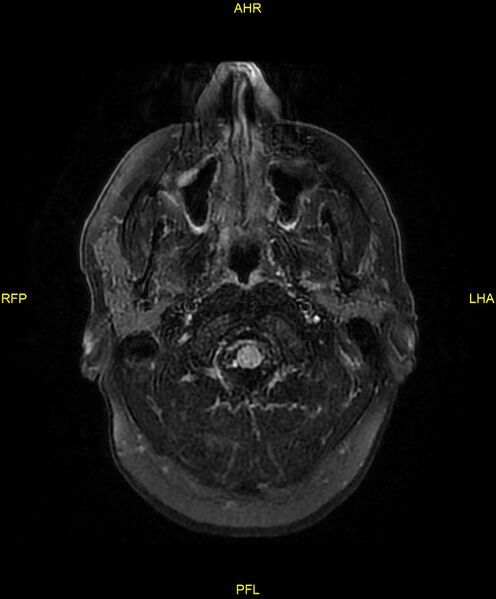 File:Cerebral autosomal dominant arteriopathy with subcortical infarcts and leukoencephalopathy (CADASIL) (Radiopaedia 86108-102054 Axial FLAIR 2).jpg