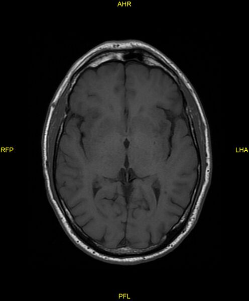 File:Cerebral autosomal dominant arteriopathy with subcortical infarcts and leukoencephalopathy (CADASIL) (Radiopaedia 86108-102054 Axial T1 15).jpg