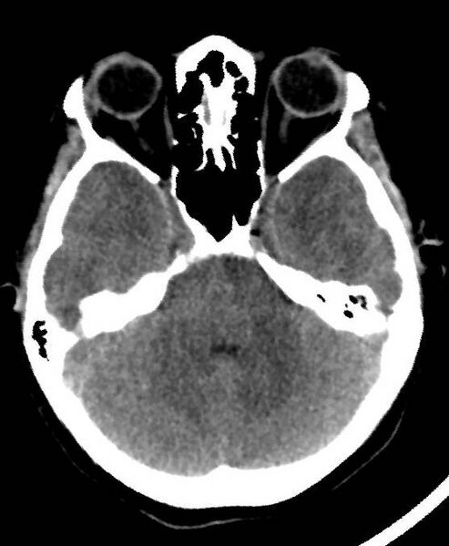 File:Cerebral edema due to severe hyponatremia (Radiopaedia 89826-106937 Axial non-contrast 26).jpg