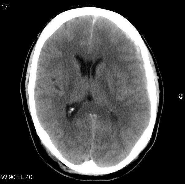 File:Cerebral hemorrhagic contusion with subdural and subarachnoid hemorrhage (Radiopaedia 10680-11146 Axial non-contrast 14).jpg