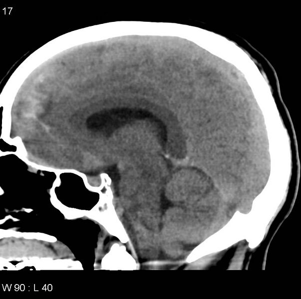 File:Cerebral hemorrhagic contusion with subdural and subarachnoid hemorrhage (Radiopaedia 10680-11146 C 10).jpg