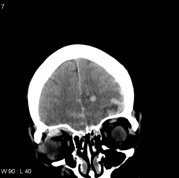 File:Cerebral hemorrhagic contusion with subdural and subarachnoid hemorrhage (Radiopaedia 10680-11146 Coronal non-contrast 3).jpg