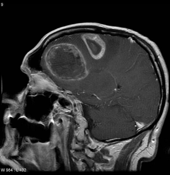 File:Cerebral metastases - renal cell carcinoma (Radiopaedia 5510-7246 Sagittal T1 C+ 1).jpg