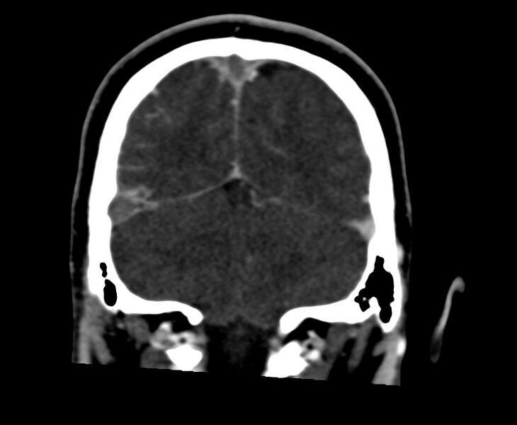 File:Cerebral venous sinus thrombosis (Radiopaedia 59224-66646 Coronal C+ delayed 62).jpg