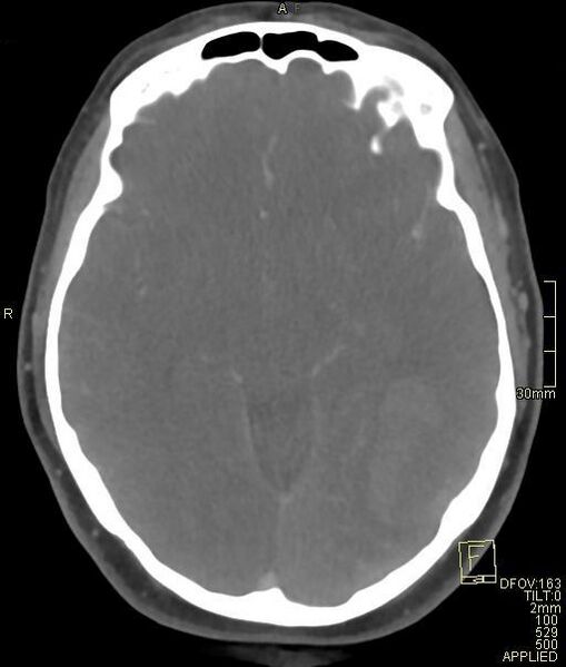 File:Cerebral venous sinus thrombosis (Radiopaedia 91329-108965 Axial venogram 37).jpg