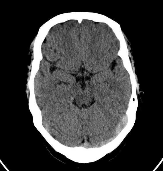 File:Cerebral venous thrombosis - CT only (Radiopaedia 41031-43778 Axial non-contrast 55).jpg