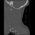 Cervical flexion teardrop fracture with cord hemorrhage (Radiopaedia 32497-33454 Sagittal bone window 39).jpg