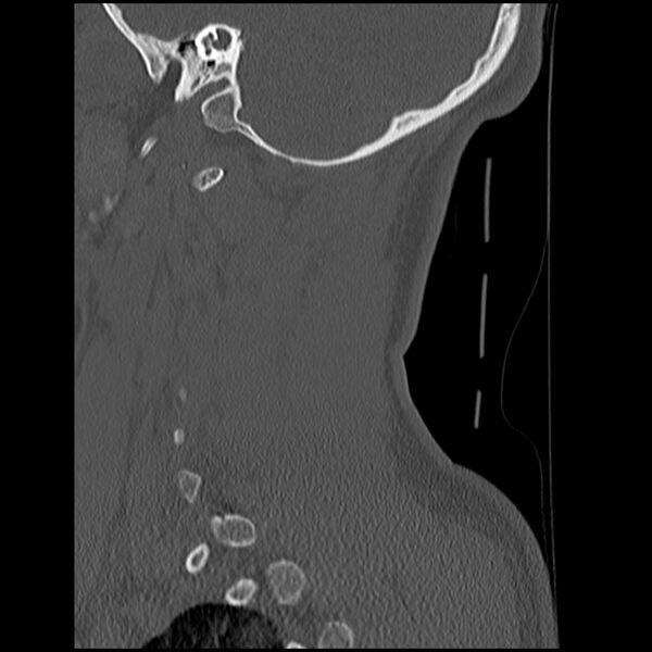 File:Cervical flexion teardrop fracture with cord hemorrhage (Radiopaedia 32497-33454 Sagittal bone window 39).jpg