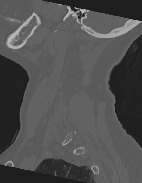 File:Cervical spine ACDF loosening (Radiopaedia 48998-54071 Sagittal bone window 18).png