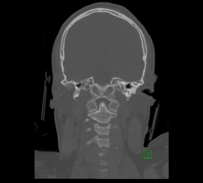 File:Cervical spine fracture - hyperflexion injury (Radiopaedia 66184-75364 Coronal bone window 3).jpg