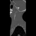 Cervical spine fractures with vertebral artery dissection (Radiopaedia 32135-33078 Sagittal bone window 40).jpg