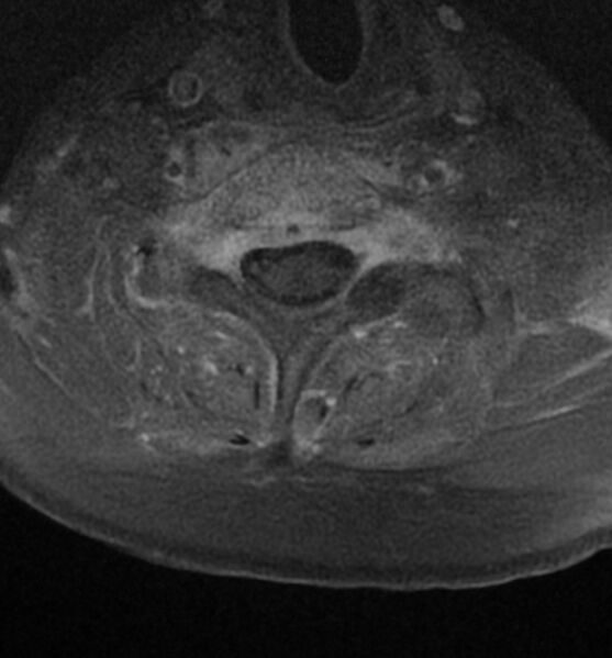 File:Cervical spondylodiscitis (Radiopaedia 81362-95110 Axial T1 C+ fat sat 14).jpg