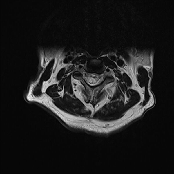 File:Cervical tumor-like myelopathy due to Type V dAVF (Radiopaedia 82461-96604 Axial T2 11).jpg