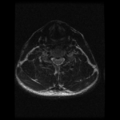Cervical vertebrae metastasis (Radiopaedia 78814-91667 Axial T2 6).png