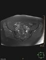 Cesarian scar endometriosis (Radiopaedia 68495-78066 Axial T1 C+ fat sat 6).jpg
