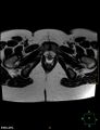 Cesarian scar endometriosis (Radiopaedia 68495-78066 Axial T2 24).jpg