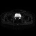 Cesarian section scar endometriosis (Radiopaedia 66520-75799 Axial DWI 20).jpg