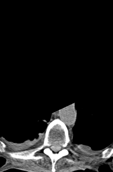 File:Chalk stick fracture (Radiopaedia 57948-64928 Axial non-contrast 77).png