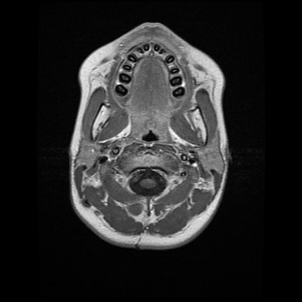File:Chiasmatic-hypothalamic juvenile pilocytic astrocytoma (Radiopaedia 78533-91236 Axial T1 C+ 1).jpg