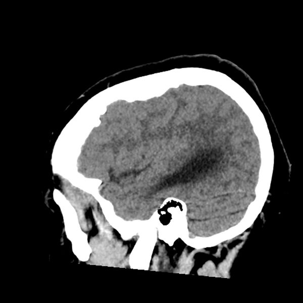 File:Chiasmatic-hypothalamic juvenile pilocytic astrocytoma (Radiopaedia 78533-91237 B 17).jpg
