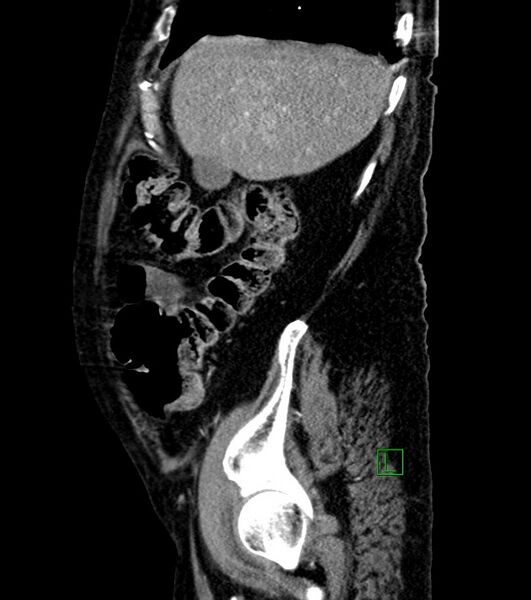 File:Cholangiocarcinoma with cerebral metastases (Radiopaedia 83519-98629 F 95).jpg