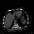Cholecystitis - CT IVC obstructive choledocholitiasis (Radiopaedia 43966-47479 C 14).png