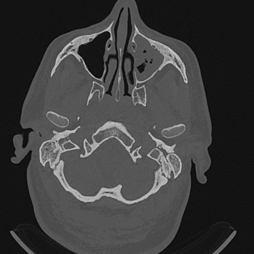 Cholesteatoma (Radiopaedia 68176-77673 Axial bone window 1).jpg