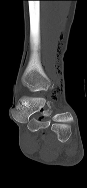 File:Chopart fracture (Radiopaedia 35347-36851 Coronal bone window 39).jpg