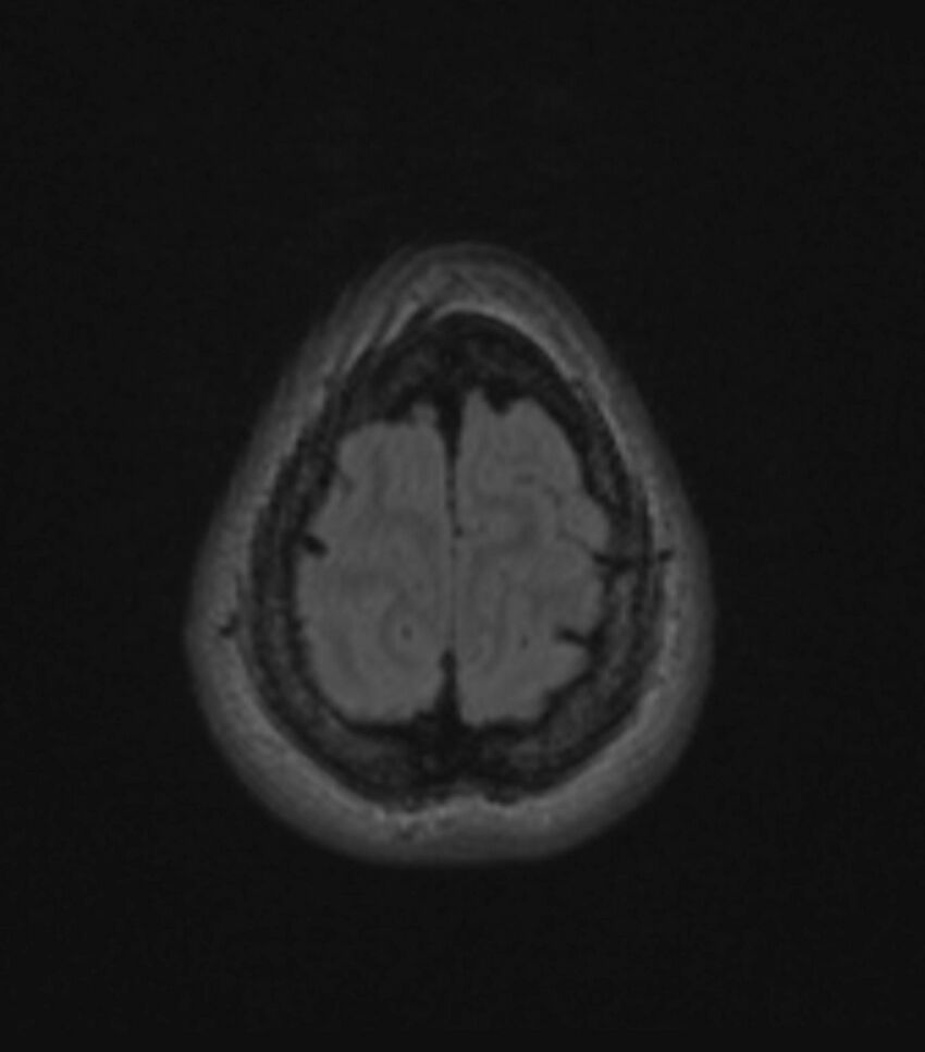 Choroid plexus carcinoma (Radiopaedia 91013-108553 Axial FLAIR C+ 193).jpg