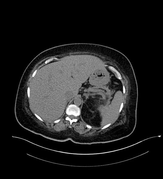 File:Chromophobe renal cell carcinoma (Radiopaedia 84239-99519 Axial non-contrast 46).jpg