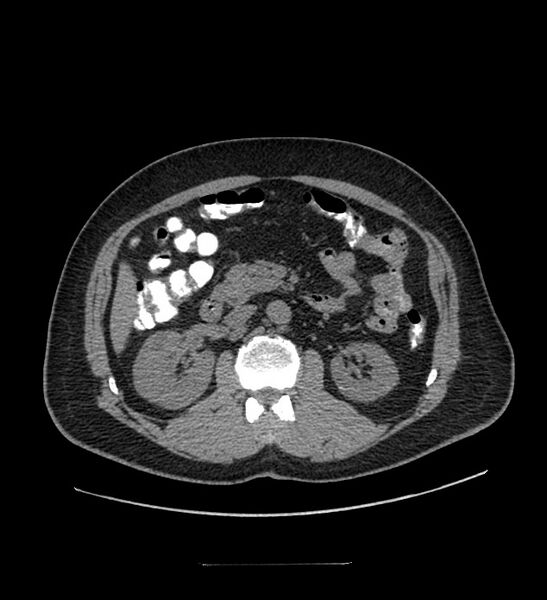 File:Chromophobe renal cell carcinoma (Radiopaedia 84337-99644 Axial non-contrast 42).jpg