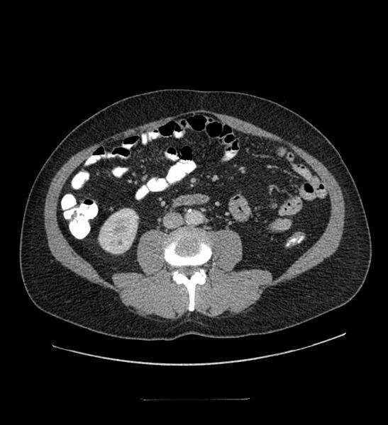 File:Chromophobe renal cell carcinoma (Radiopaedia 84337-99644 C 72).jpg