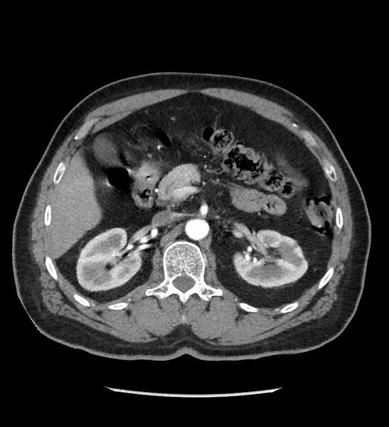 File:Chromophobe renal cell carcinoma (Radiopaedia 86879-103083 B 51).jpg