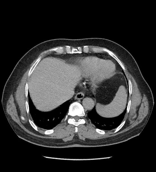 File:Chromophobe renal cell carcinoma (Radiopaedia 86879-103083 D 10).jpg