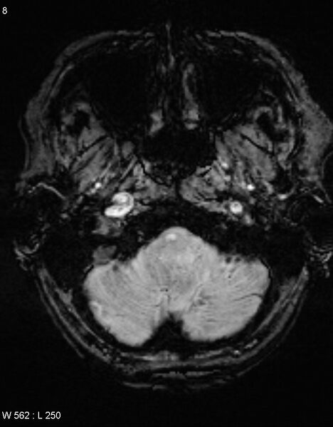 File:Chronic lymphocytic inflammation with pontine perivascular enhancement responsive to steroids (CLIPPERS) (Radiopaedia 37520-39374 Axial SWI 7).jpg