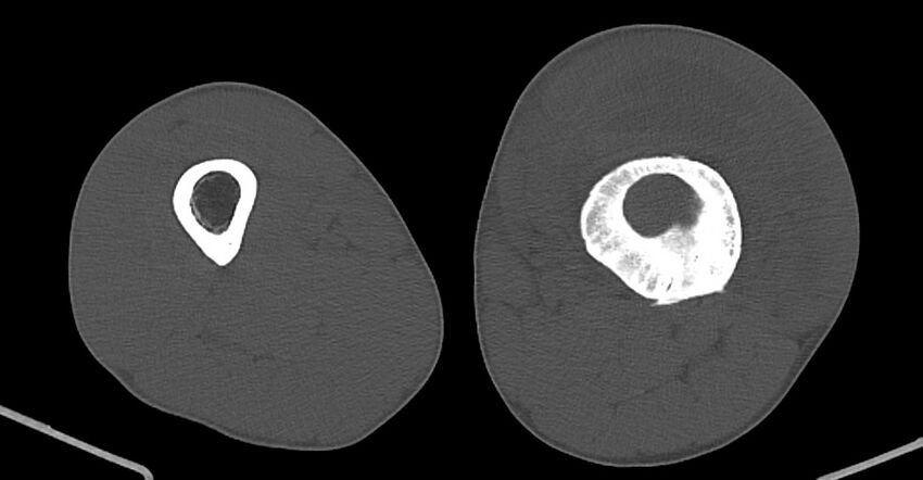 Chronic osteomyelitis (with sequestrum) (Radiopaedia 74813-85822 Axial non-contrast 117).jpg
