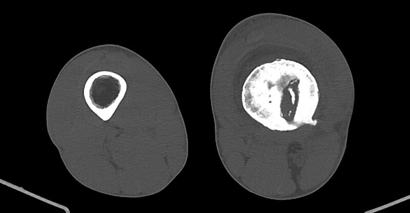 File:Chronic osteomyelitis (with sequestrum) (Radiopaedia 74813-85822 Axial non-contrast 141).jpg
