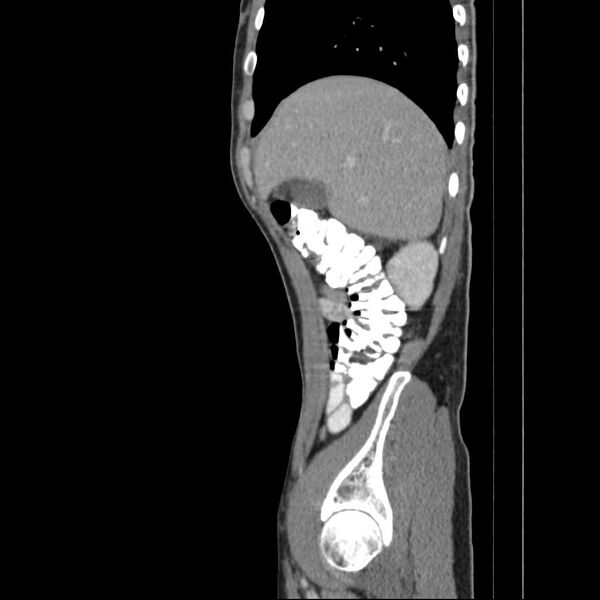 File:Chronic pancreatitis (Radiopaedia 21022-20949 D 16).jpg
