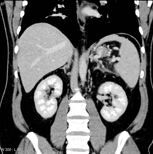 File:Chronic pancreatitis and pseudocysts (Radiopaedia 6724-7935 E 12).jpg