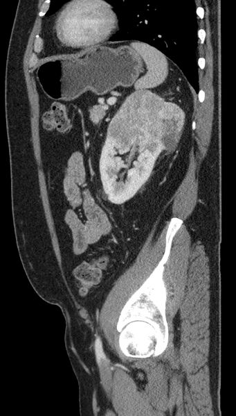 File:Clear cell renal cell carcinoma (Radiopaedia 61449-69393 G 23).jpg