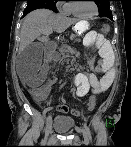 File:Closed-loop small bowel obstruction-internal hernia (Radiopaedia 78439-91096 Coronal non-contrast 44).jpg