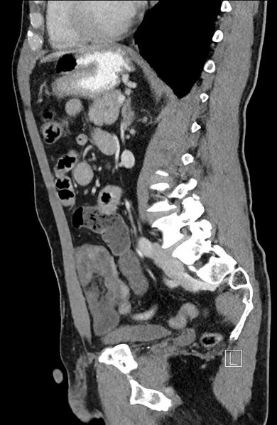 File:Closed loop small bowel obstruction - internal hernia (Radiopaedia 57806-64778 C 47).jpg