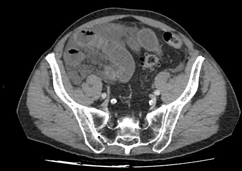 File:Closed loop small bowel obstruction with ischemia (Radiopaedia 84180-99456 A 92).jpg