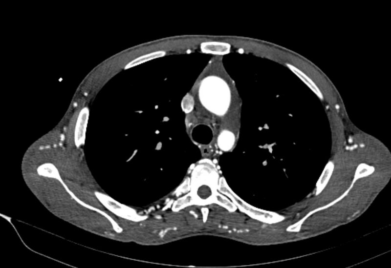 File:Coarctation of aorta with aortic valve stenosis (Radiopaedia 70463-80574 A 49).jpg