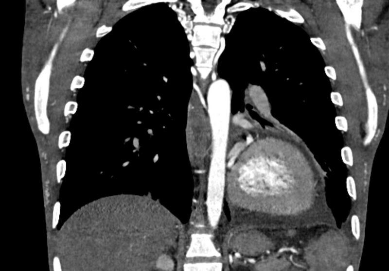 File:Coarctation of aorta with aortic valve stenosis (Radiopaedia 70463-80574 C 162).jpg