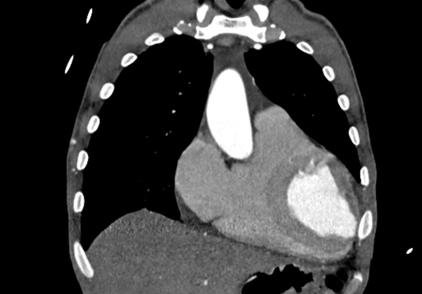 Coarctation of aorta with aortic valve stenosis (Radiopaedia 70463-80574 C 50).jpg