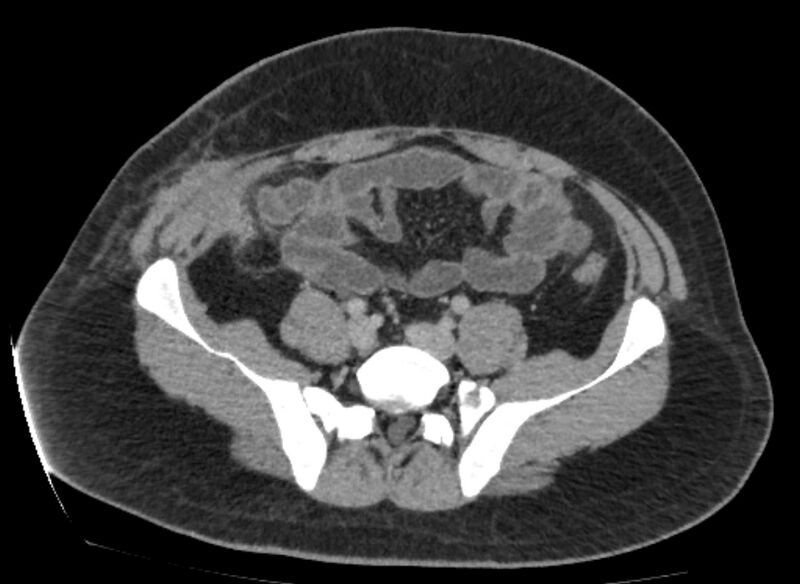 File:Colocutaneous fistula (Radiopaedia 56401-63062 A 66).jpg