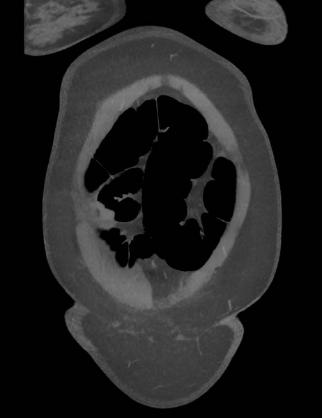 File:Colonic pseudo-obstruction (Radiopaedia 79752-92980 B 14).png