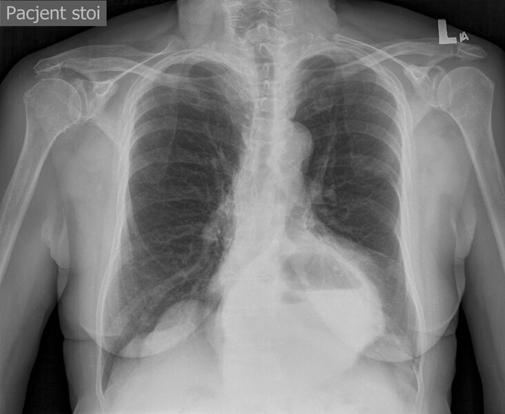 File:Hiatus hernia (para-esophageal hernia) on chest X-ray (Radiopaedia 40827).jpg