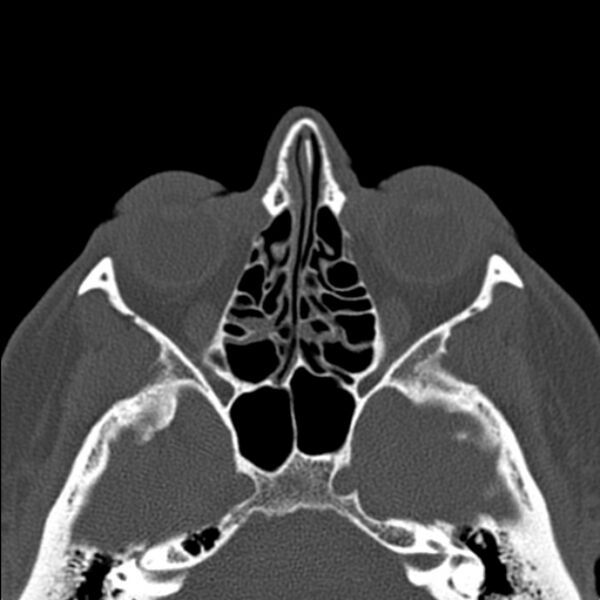 File:Nasal septal perforation (Radiopaedia 25030-25289 Axial bone window 34).jpg